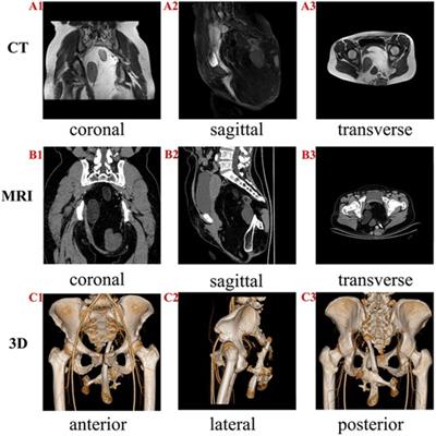 Case report: Resection of a massive primary sacrococcygeal mature teratoma in an adult using 3-dimensional reconstruction and mixed reality technology